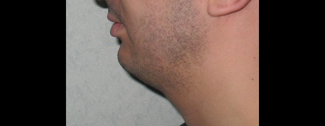 Pas d'angle cervical