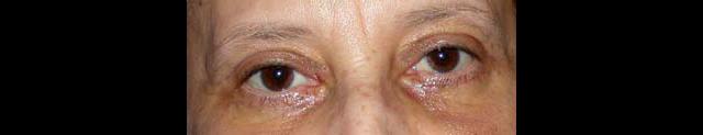 chirurgie-esthetique-interventions-paupieres-blépharoplasties