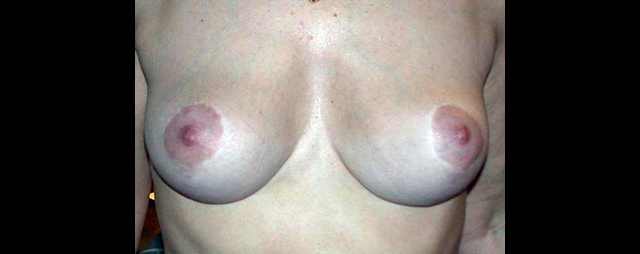 chirurgie-esthetique-interventions-seins-reductions-mammaires