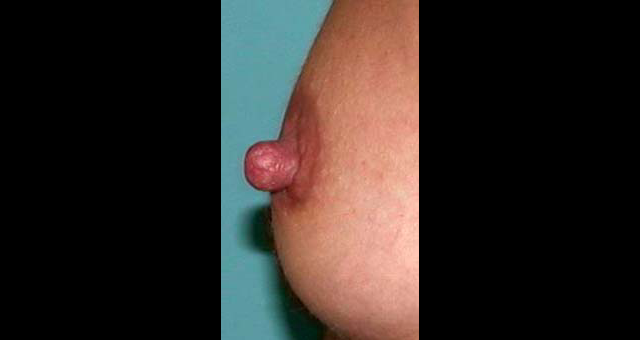 chirurgie-esthetique-interventions-seins-reduction-mamelon
