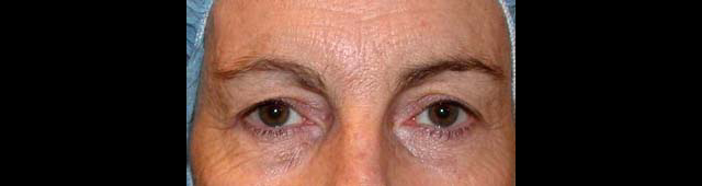 chirurgie-esthetique-interventions-paupieres-blépharoplasties