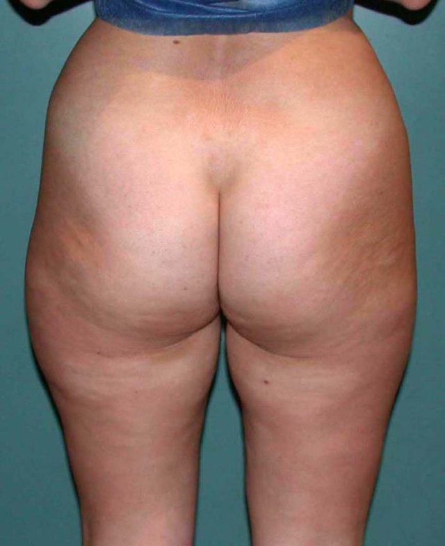 surcharge graisseuse des cuisses