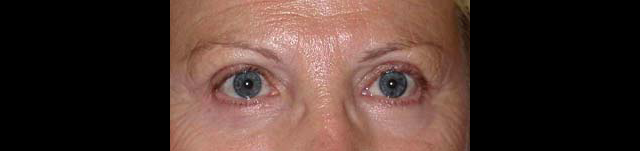 chirurgie-esthetique-interventions-paupieres-blépharoplasties