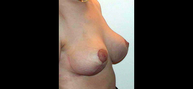 chirurgie-esthetique-interventions-seins-reductions-mammaires