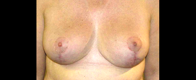 chirurgie-esthetique-interventions-seins-reductions-mammaires