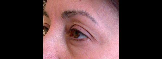 chirurgie-esthetique-interventions-paupieres-blépharoplasties