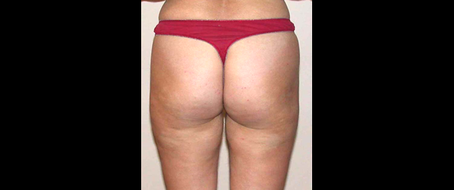 chirurgie-esthetique-interventions-lipoaspirations-liposuccions