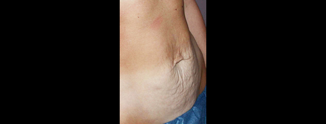 chirurgie-esthetique-interventions-abdomens-abdominoplasties