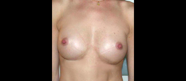 chirurgie-esthetique-interventions-seins-augmentations-mammaires