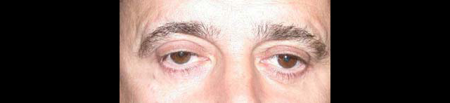 chirurgie-esthetique-interventions-paupieres-blépharoplasties