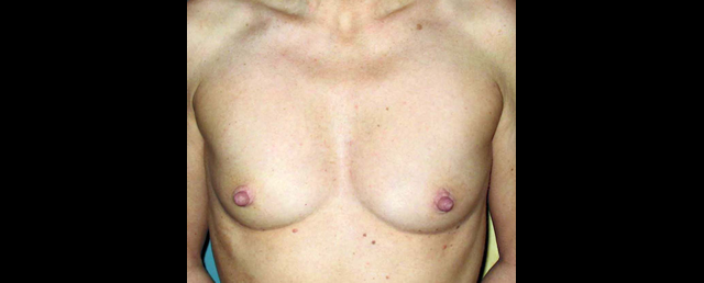 chirurgie-esthetique-interventions-seins-augmentations-mammaires