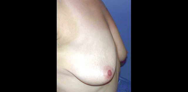 chirurgie-esthetique-interventions-seins-ptoses-mammaires-sans-implant