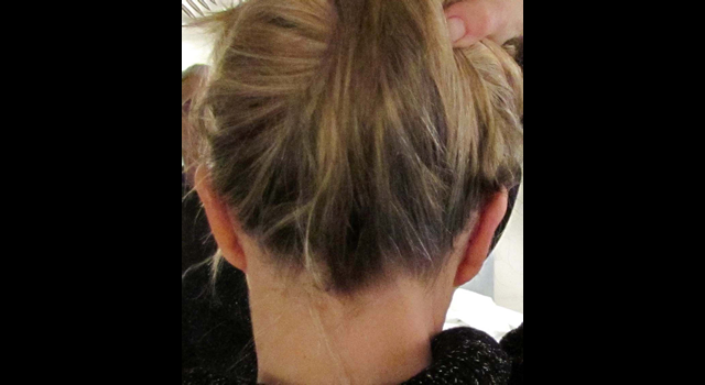 chirurgie-esthetique-pierre-nahon-interventions-oreilles-13
