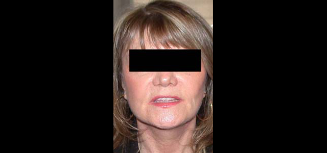 chirurgie-esthetique-interventions-visage-liftings