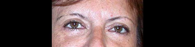 chirurgie-esthetique-interventions-paupieres-blépharoplasties