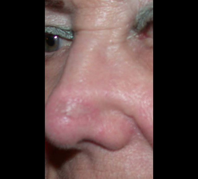 chirurgie-esthetique-cancer-greffe-resultat