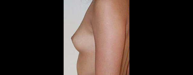 chirurgie-esthetique-interventions-seins-augmentations-mammaires