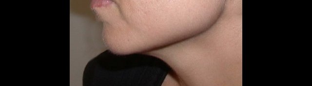 recul du menton vue de profil