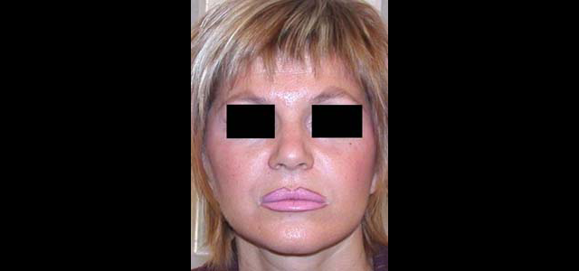 chirurgie-esthetique-interventions-visage-liftings
