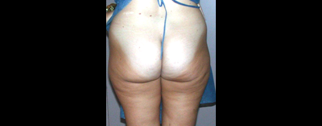 chirurgie-esthetique-interventions-lipoaspirations-liposuccions