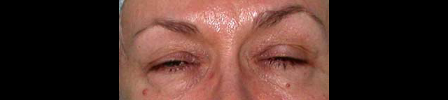 chirurgie-esthetique-interventions-paupieres-blépharoplasties