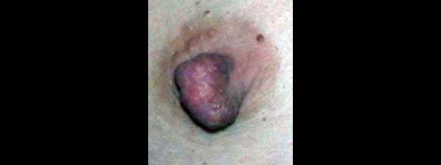 chirurgie-esthetique-interventions-seins-reduction-mamelon