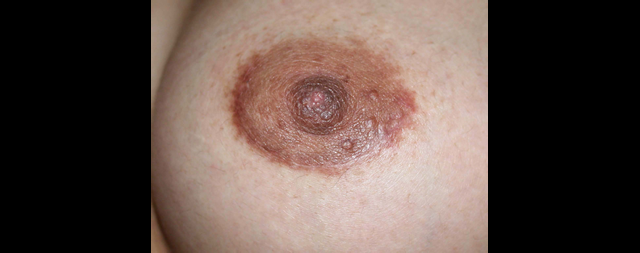 chirurgie-esthetique-interventions-seins-augmentations-mammaires