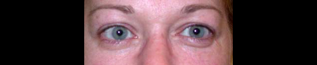 chirurgie-esthetique-interventions-paupieres-blépharoplasties