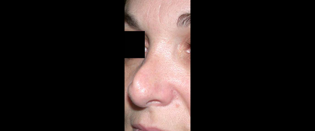 chirurgie-esthetique-chirurgie-secondaire-nez-rhinoplastie-secondaire