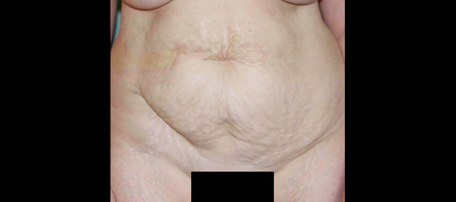 chirurgie-esthetique-interventions-abdomens-abdominoplasties