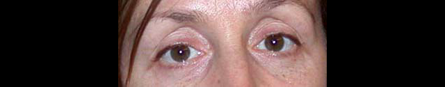chirurgie-esthetique-interventions-paupieres-blépharoplasties