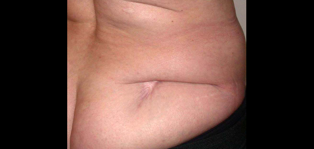 chirurgie-esthetique-interventions-cicatrices-grains-beauté-kystes-tatouages