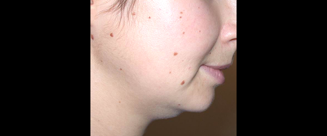 chirurgie-esthetique-interventions-lipoaspirations-liposuccions