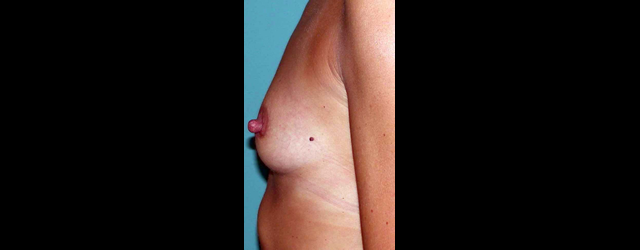 chirurgie-esthetique-interventions-seins-augmentations-mammaires