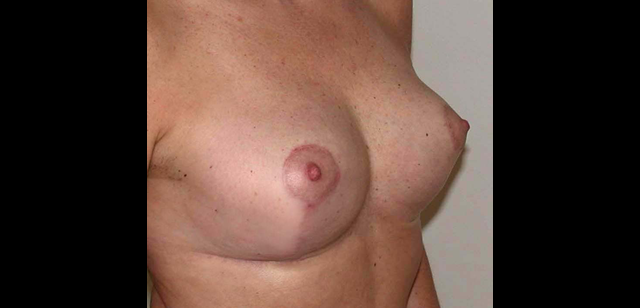 chirurgie-esthetique-interventions-seins-ptoses-mammaires-sans-implant