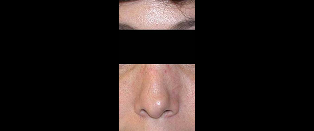 chirurgie-esthetique-chirurgie-secondaire-nez-rhinoplastie-secondaire