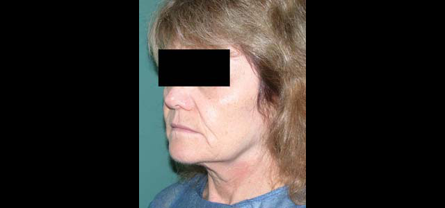 chirurgie-esthetique-interventions-visage-liftings