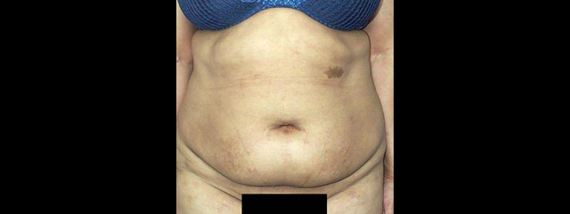 chirurgie-esthetique-interventions-abdomens-abdominoplasties