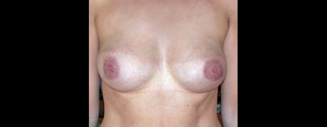 chirurgie-esthetique-interventions-seins—reduction-areoles-1