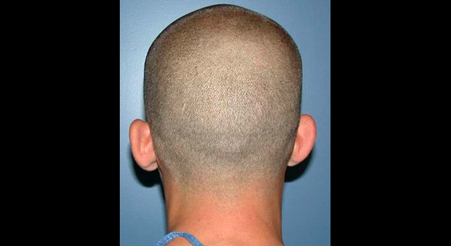 chirurgie-esthetique-pierre-nahon-interventions-oreilles-08