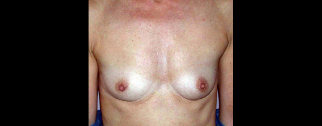 chirurgie-esthetique-interventions-seins-augmentations-mammaires