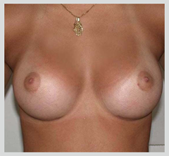 La FDA signale un nouveau risque pour les implants mammaires